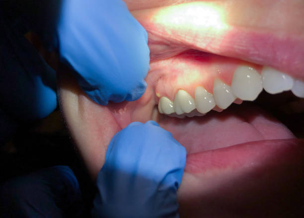 Best Emergency Treatment for Dental Infections or Abscesses in Spring Valley Lake, CA
